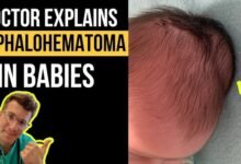 cephalohematoma