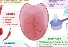 lie bumps on tongue