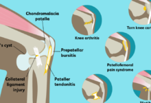 why does my knee hurt when i bend it
