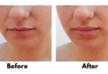 lip flip before and after