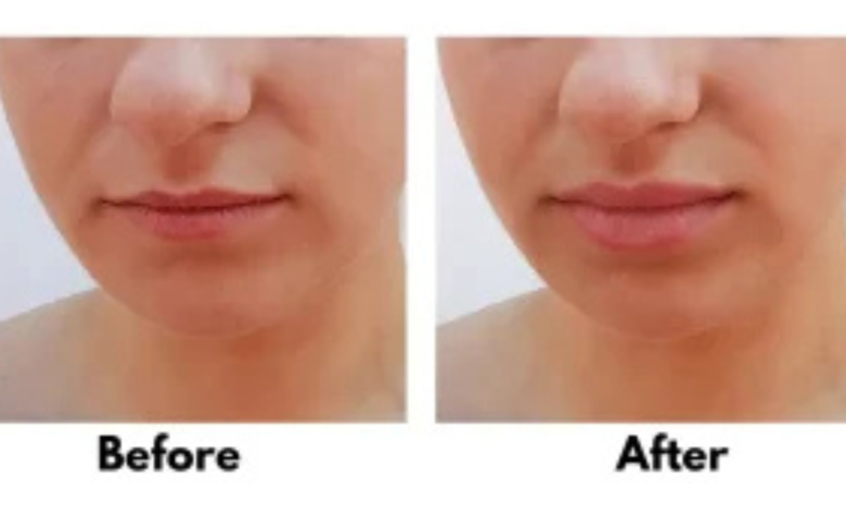 lip flip before and after